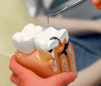 How Root Canal Therapy Helps Save Your Tooth and Protect Oral Health